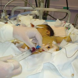 Гемолитическое заболевание у новорожденных