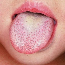 Заболевания желудочно-кишечного тракта в полости рта